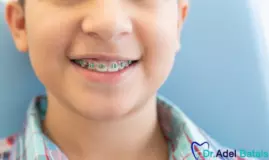 تقويم الأسنان للأطفال