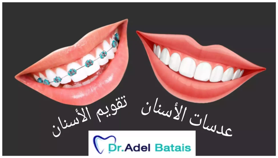 تقويم الأسنان أو عدسات الأسنان؟